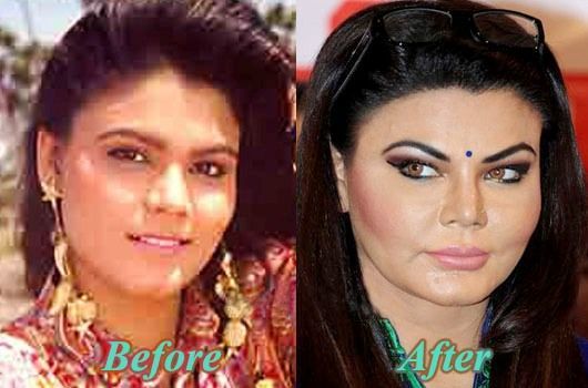 Ракхи Савант преди и след