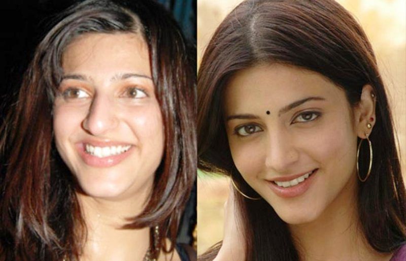 Shruti Haasan vor und nach der plastischen Chirurgie