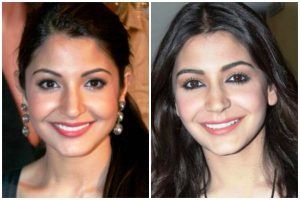 Anushka Sharma enne ja pärast ilukirurgiat