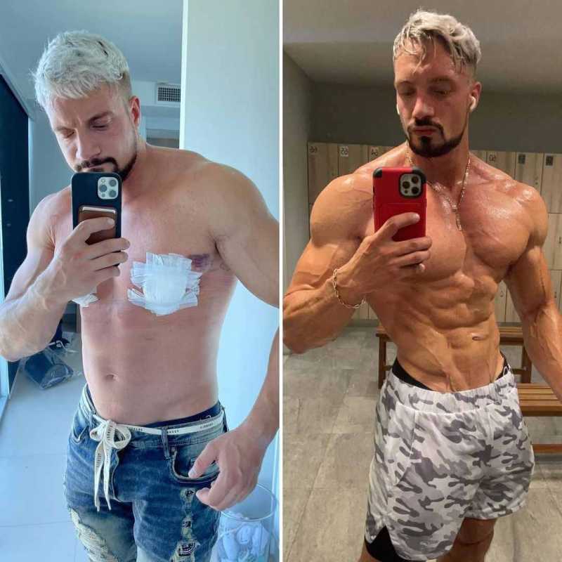 Jo Lindner သည် Gynecomastia အတွက် ခွဲစိတ်ကုသမှုခံယူပြီးနောက် ဓာတ်ပုံများကို မျှဝေခဲ့သည်။